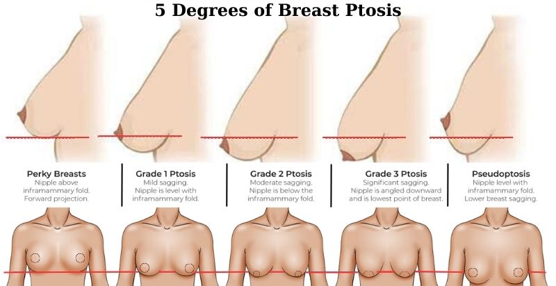 Breast Lifting Surgery Turkey