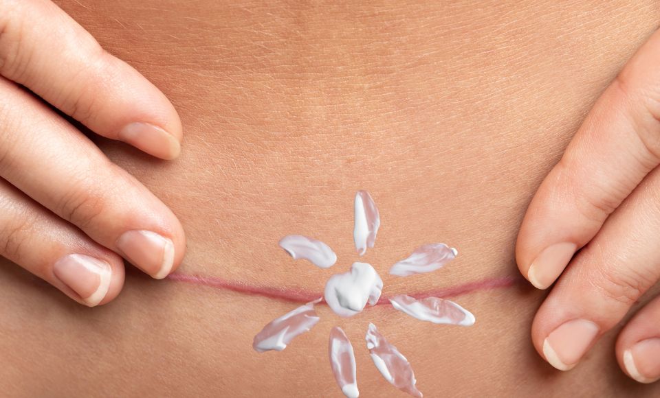 Protect Tummy Tuck Scars From The Sun