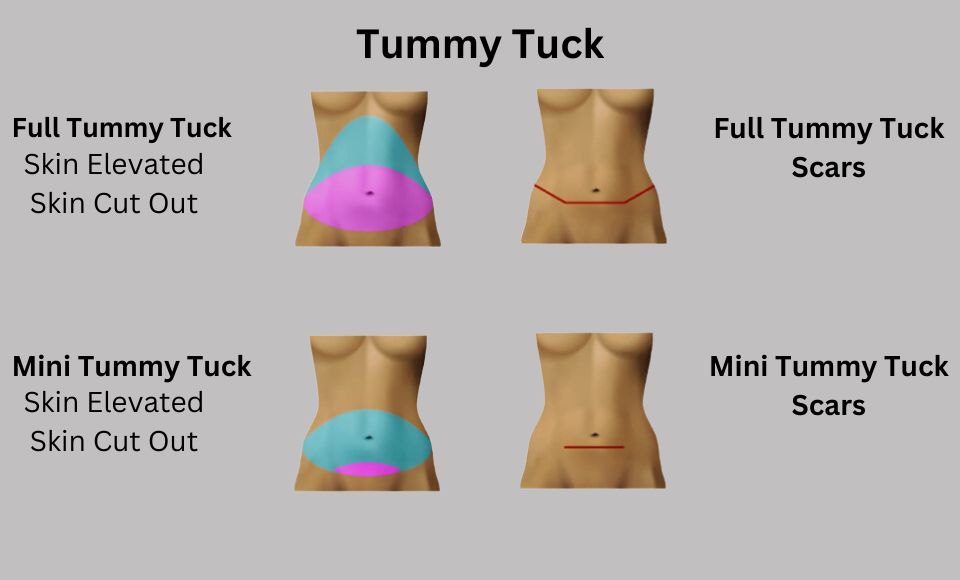 Full vs Mini Tummy Tuck Scars
