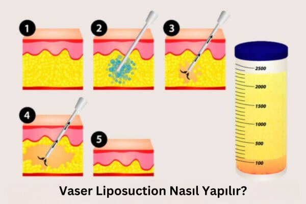 Antalya Vaser Liposuction Nasıl Yapılır?