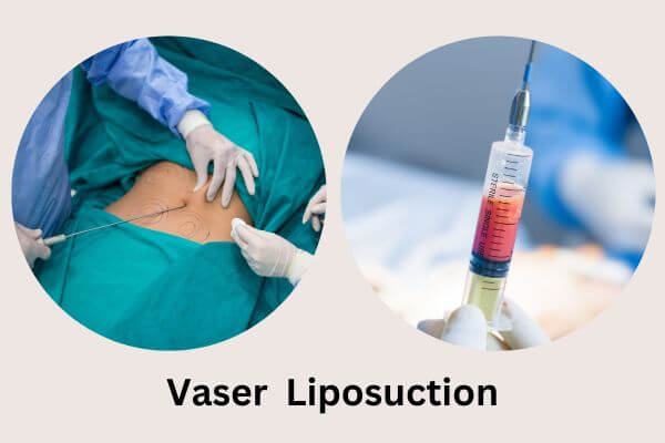 what is vaser liposuction?